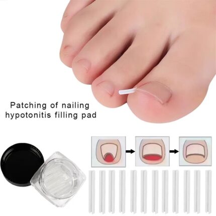 Ingrown Toenail Correction Tool